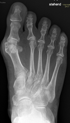 Hallux valgus Fehlstellung