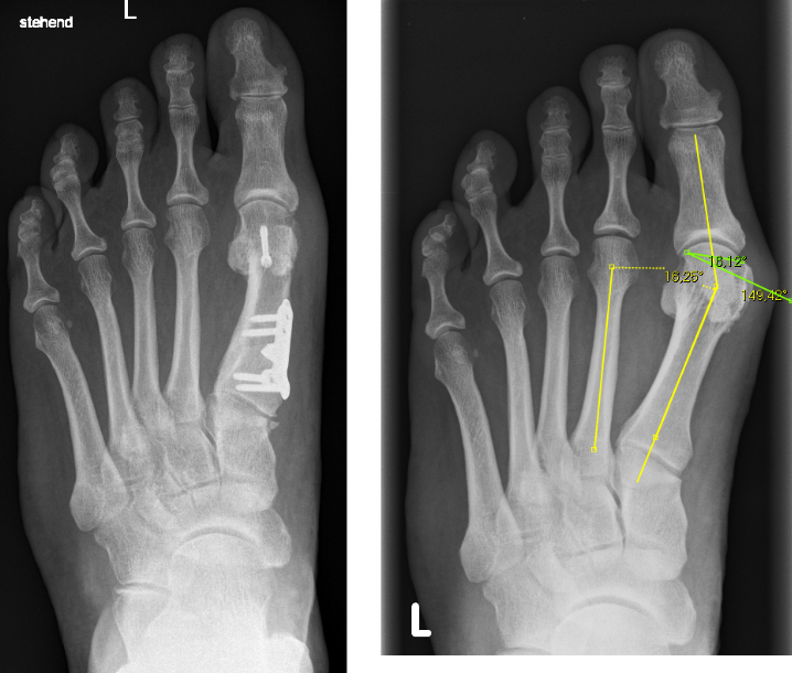 Hallux valgus Zwei-Etagen Korrektur