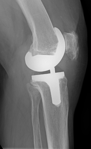 Kniegelenkersatz seitlich