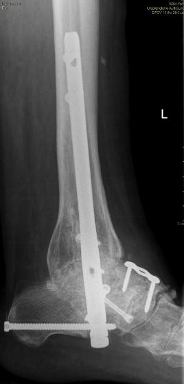 Kombinierte obere und untere Sprunggelenkversteifung
