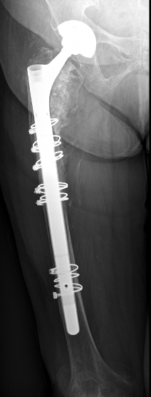 Komplexe Hüftgelenkersatz bei periprothetische Fraktur