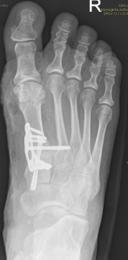 Mod. Lapidusarthrodese bei Hallux valgus Fehlstellung