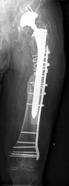 Osteosynthese eine periprothetische Oberschenkelfraktur