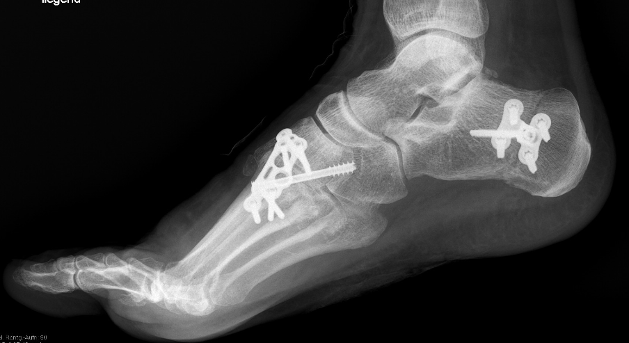 Plattfuß mit Hallux valgus Korrektur