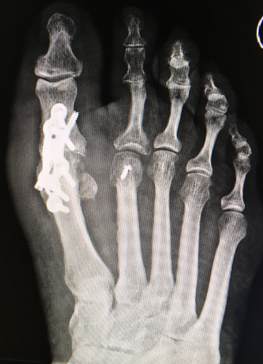 Versteifung des Großenzehegrundgelenk bei Hallux rigidus