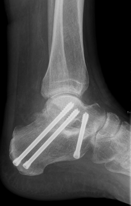 Versteifung von unteren Sprunggelenk